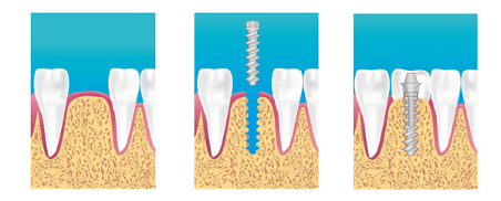 étapes de la pose d'implant dentaire à la couronne dentaire eric crichton cabinet implantologie le vesinet yvelines paris