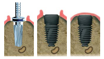 etapes de la pose d'implant dentaire eric crichton cabinet implantologie le vesinet yvelines paris